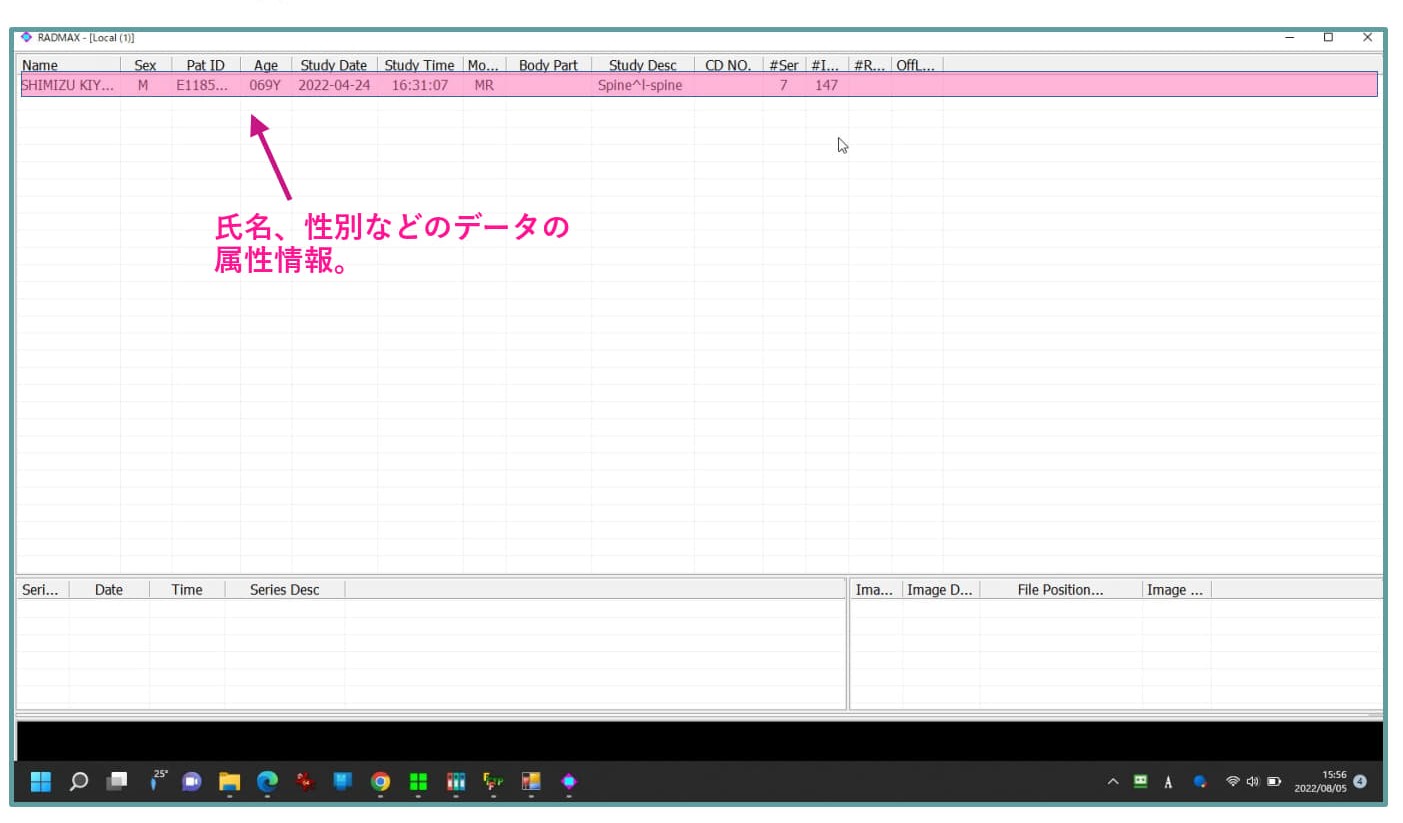 MiniRADMAX procedure 1
