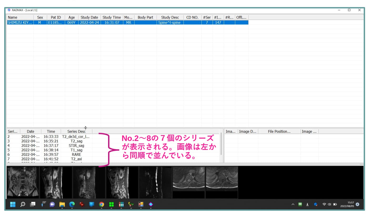 MiniRADMAX procedure 2