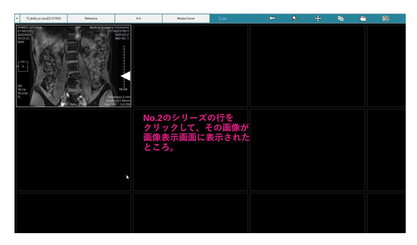 MiniRADMAX procedure 3