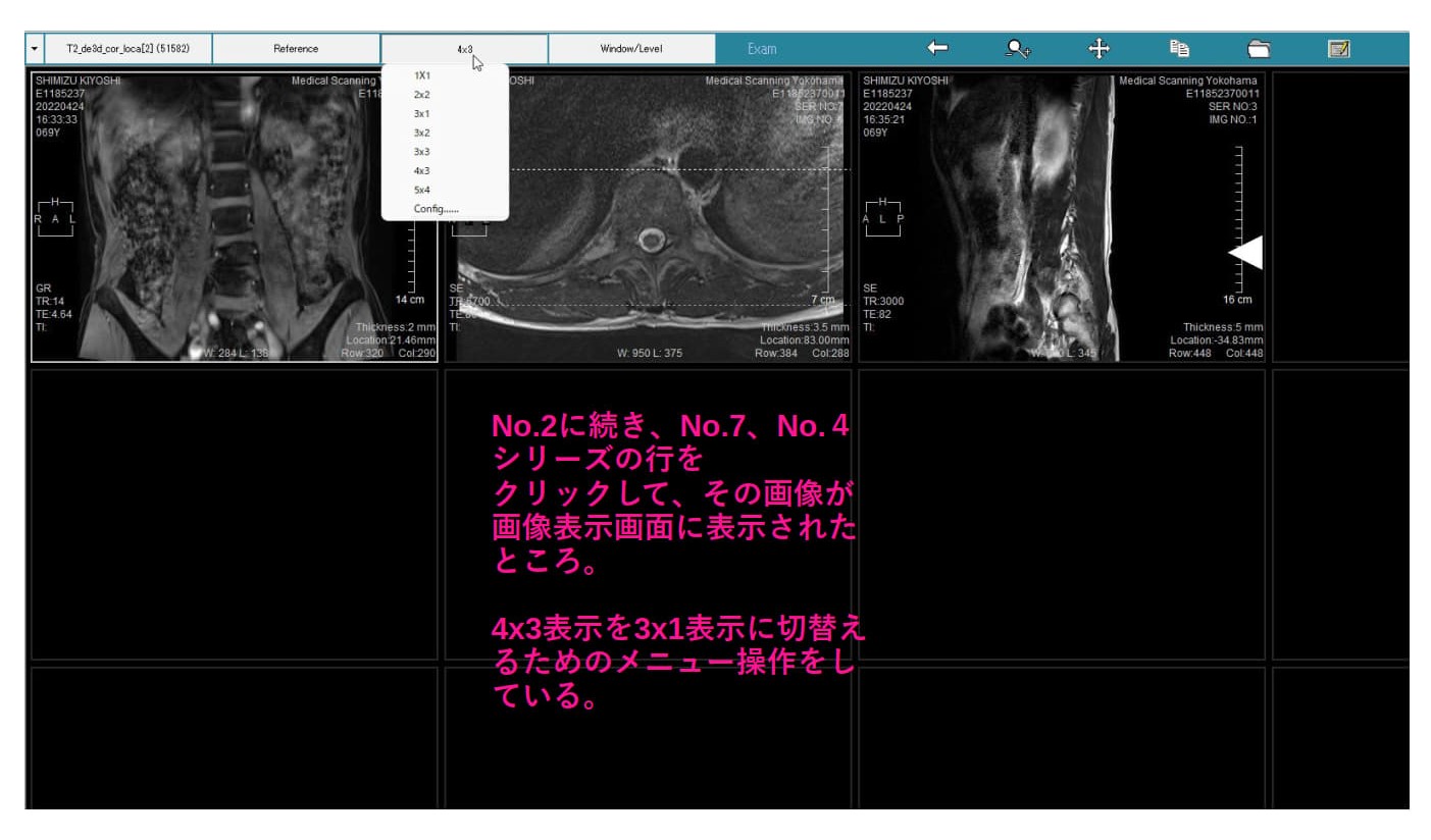MiniRADMAX procedure 4