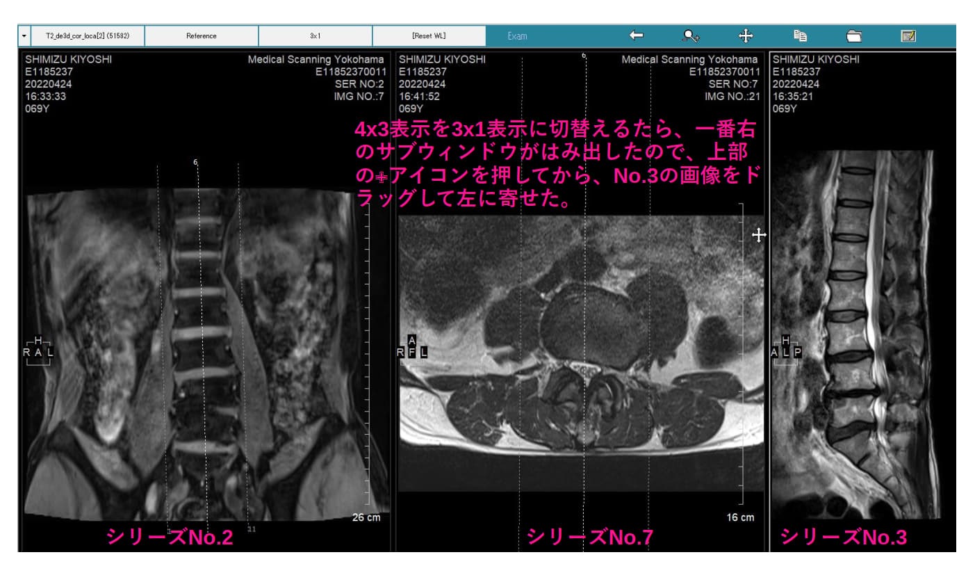 MiniRADMAX procedure 5
