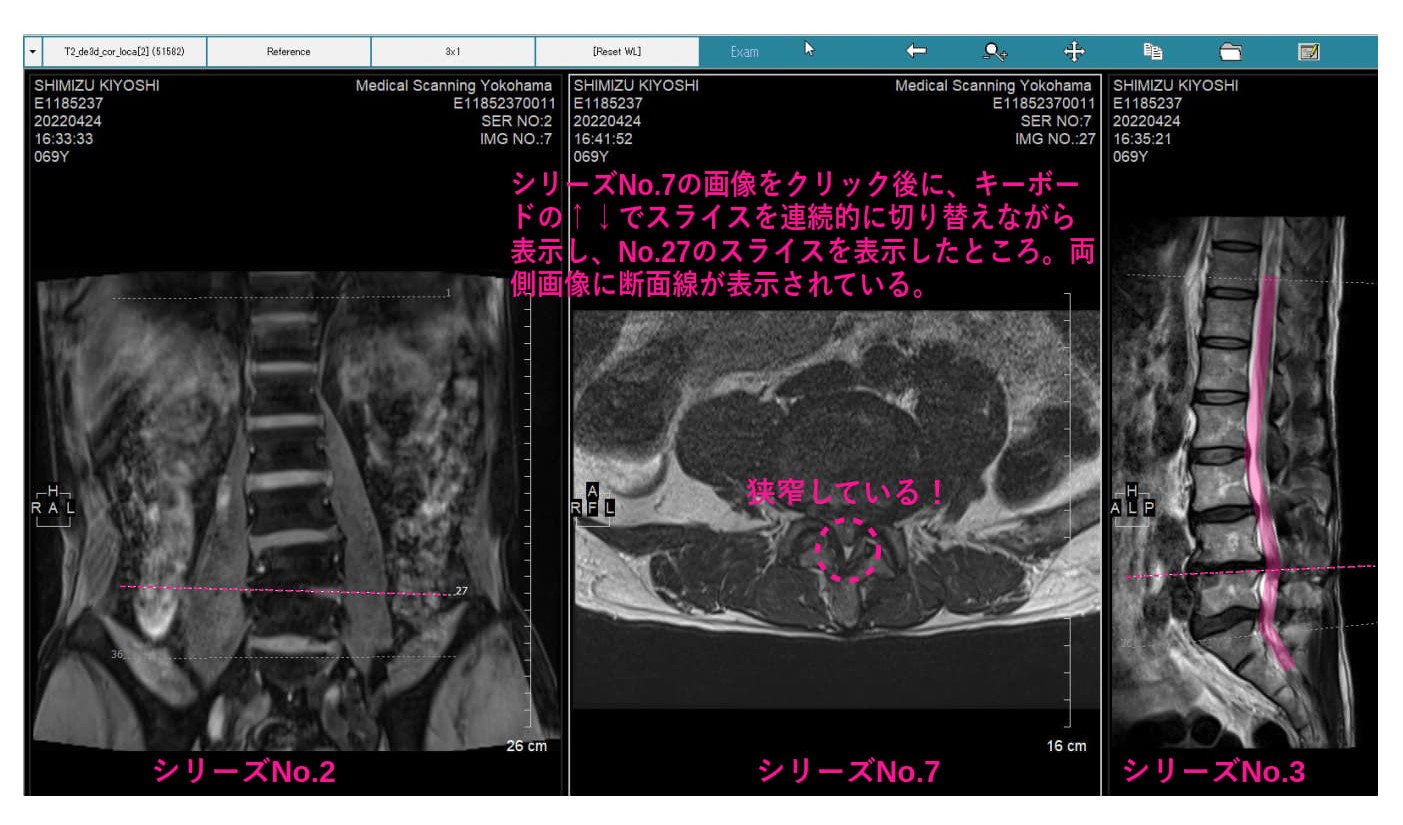 MiniRADMAX procedure 6